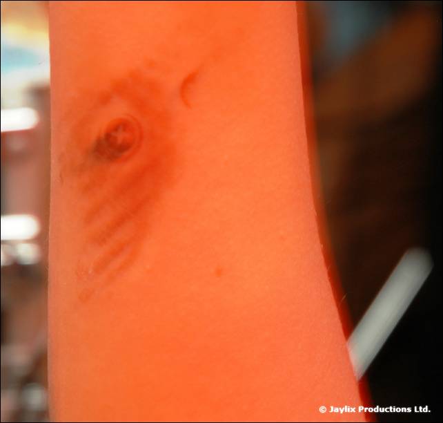 Close-up of a bare orange-lit arm with a small circular mark near the elbow